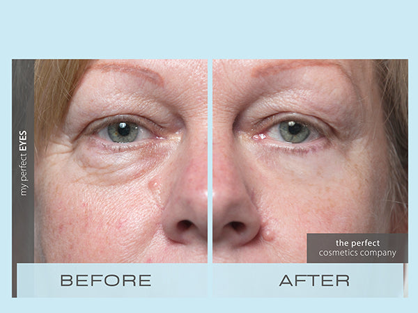 Can You Achieve the Look of a Lower Blepharoplasty Without Surgery?
